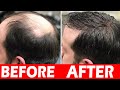 Permanent Solution For Hair Fall | Causes For Hair Loss | DR Navya | Health And Beauty