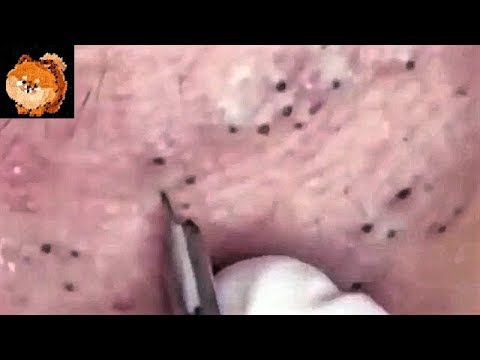 Most Satisfying Acne, Blackheads Removal Video with Relaxing Music Sleep (Part )