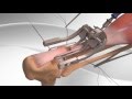 Achilles tendon rupture repair with arthrex pars system