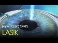 LASIK Eye Correction Surgery