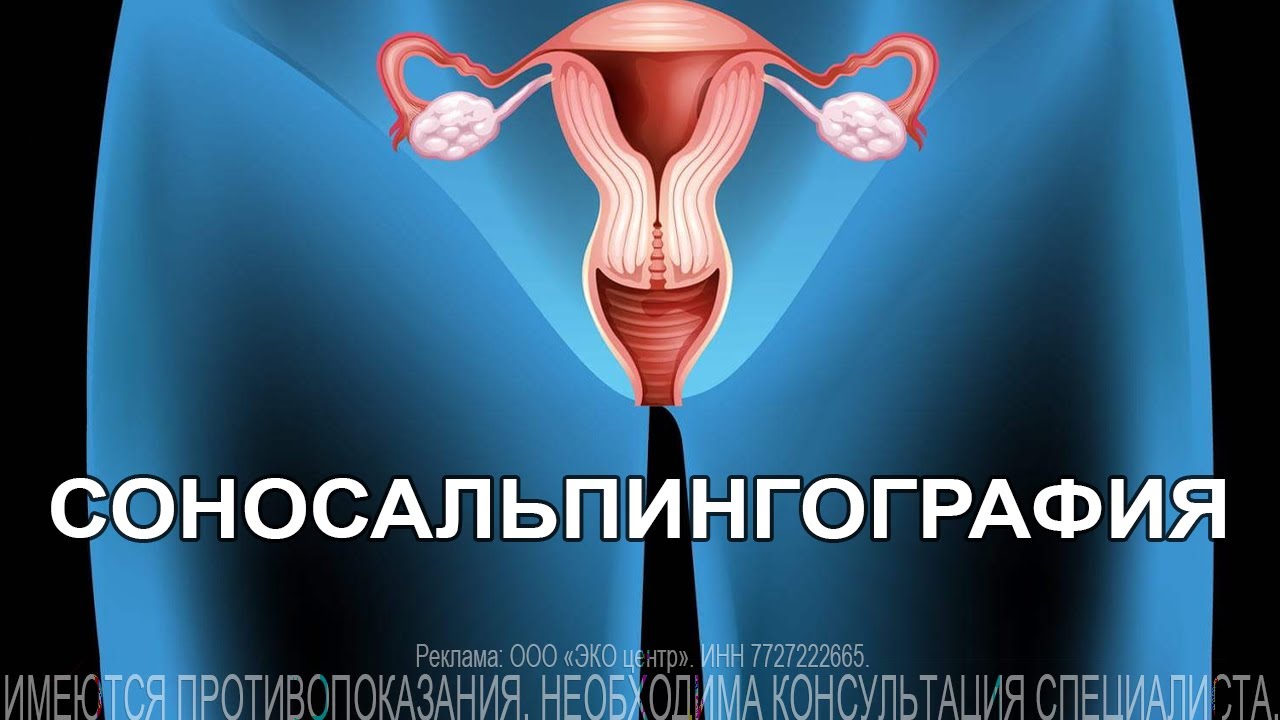 Соносальпингография в программах ЭКО.