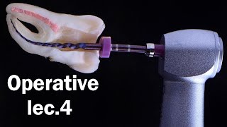 ترميم الاسنان المحاضرة الرابعة - CLASS III AMALGAM RESTORATION