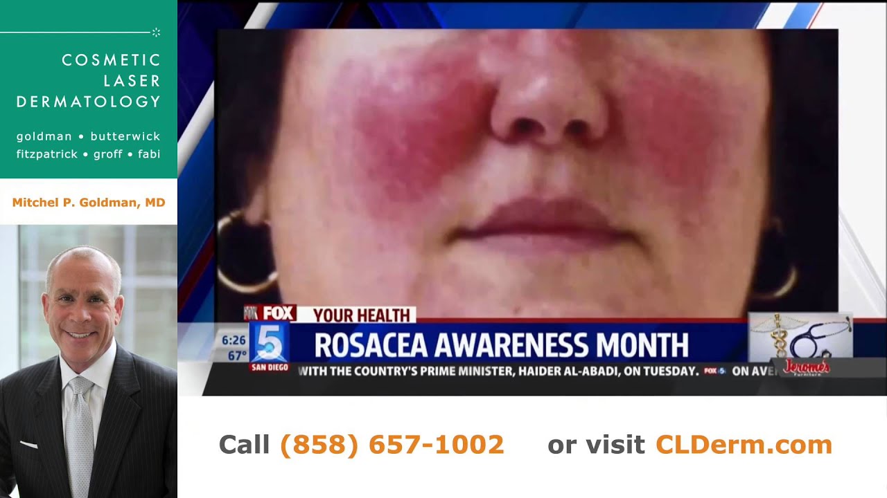 Banner for Rosacea Awareness | Expert San Diego Dermatologist Dr. Goldman