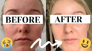Rosacea Skin Care | Products you NEED to try if you have rosacea / redness
