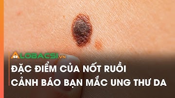 Đặc điểm của nốt ruồi cảnh báo bạn mắc ung thư da