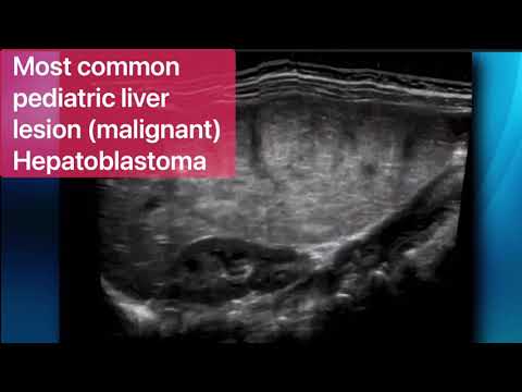 Mesenchymal Hamartoma