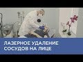 Удаление сосудов на лице на лазере Cutera XEO в Астрахани