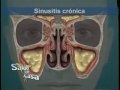Cirugía de Sinusitis: Relación con septo nasal  y cornetes