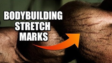 Bodybuilding Stretch Marks: Can They Be Eliminated?