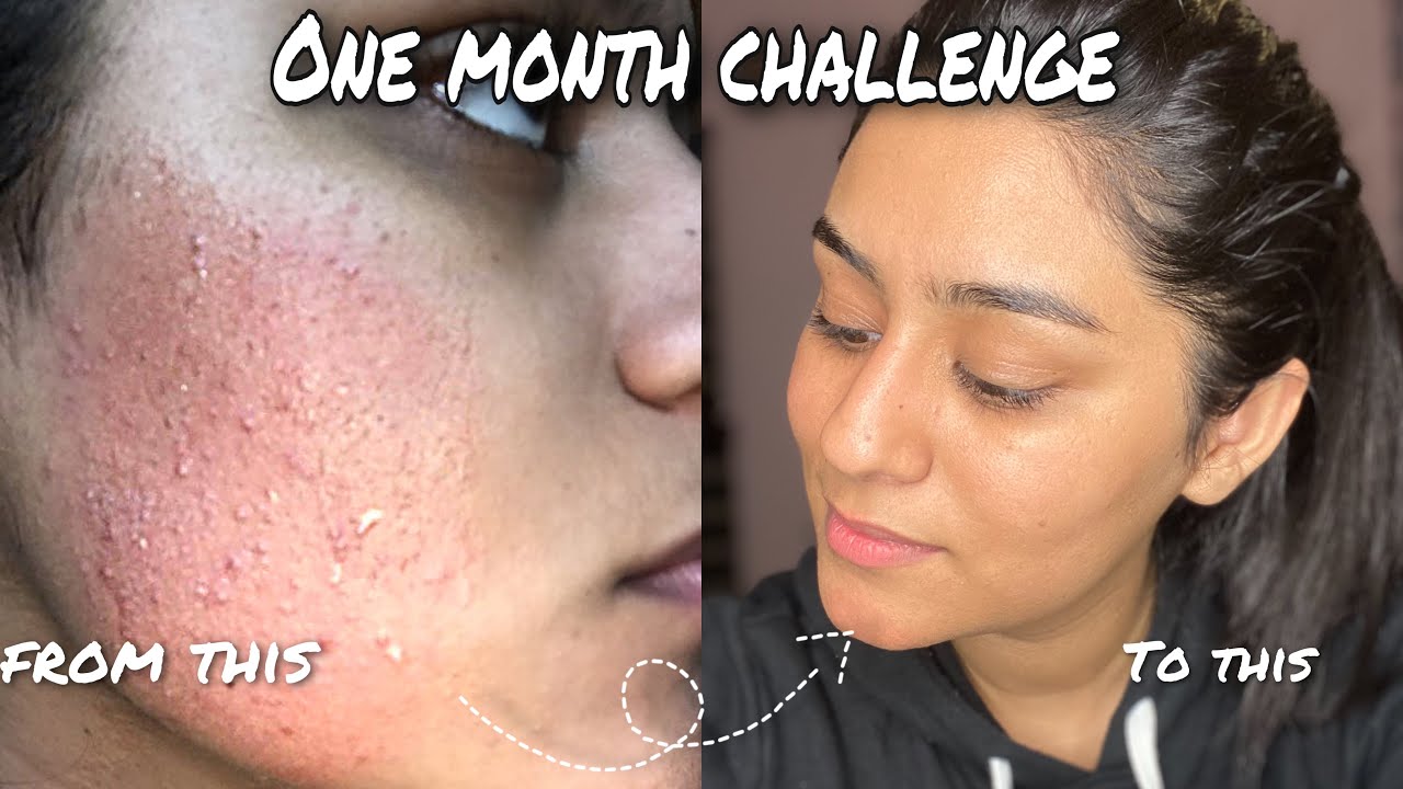 How I cleared my Skin in a Month | Challenge Yourself | Easiest ...