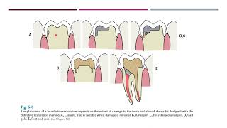 Mouth preparation in fixed prosthodontics