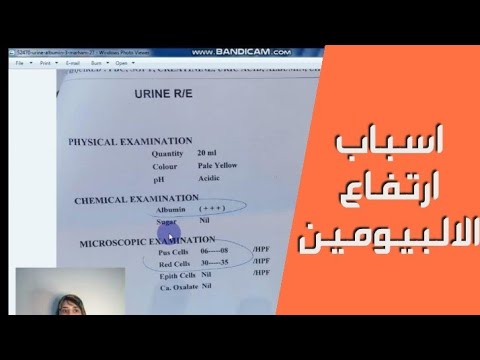 تحليل الالبومين واسباب ارتفاع نسبته