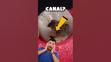Root Canal Explained !?
