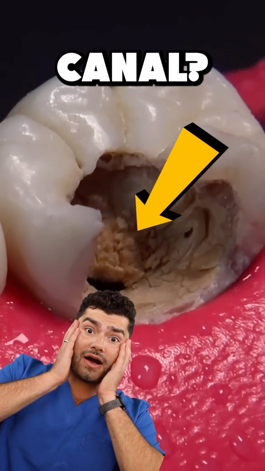 Root Canal Explained !?