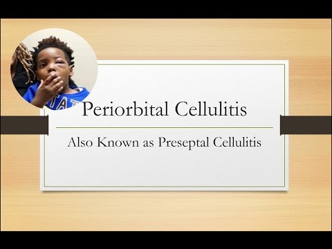 Video: Er periorbital cellulitis en nødsituation?