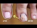 BROKEN TOENAIL TRANSFORMATION AT HOME | DIY TOE NAIL EXTENSION FOR BEGINNERS using MADAM GLAM