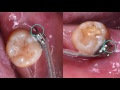 【Chris Chang Ortho】427. Clinical Tip: How to Secure the Wire End by Dr. Ashley Huang