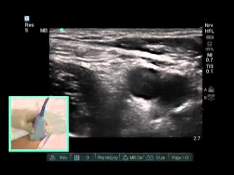 How to: Ultrasound Guided Femoral Nerve Block - YouTube