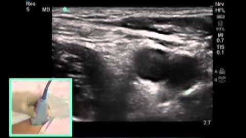 How To: FEMORAL NERVE BLOCK - Dr. Auyong Scanning Technique Video