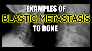 Examples of Blastic Metastasis to Bone #doctor #cancer #bones