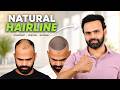 Hair Transplant in Ludhiana (HX-AHJT) | Best Results &amp; Cost of Hair Transplant in Ludhiana