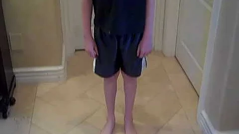 Ponseti Clubfoot Joshua 11 years old