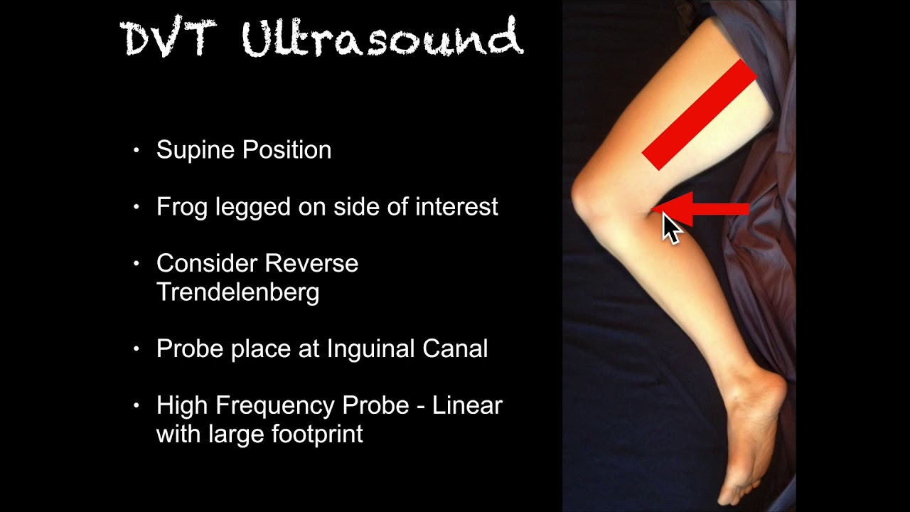 blood clot in leg ultrasound