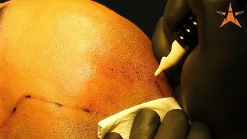 The Journey Of A Scalp Micropigmentation Procedure