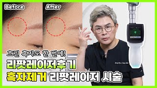 [리팟레이저후기] 흑자제거 리팟레이저 시술
