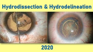 Hydrodissection & Hydrodelineation in Phaco. #002