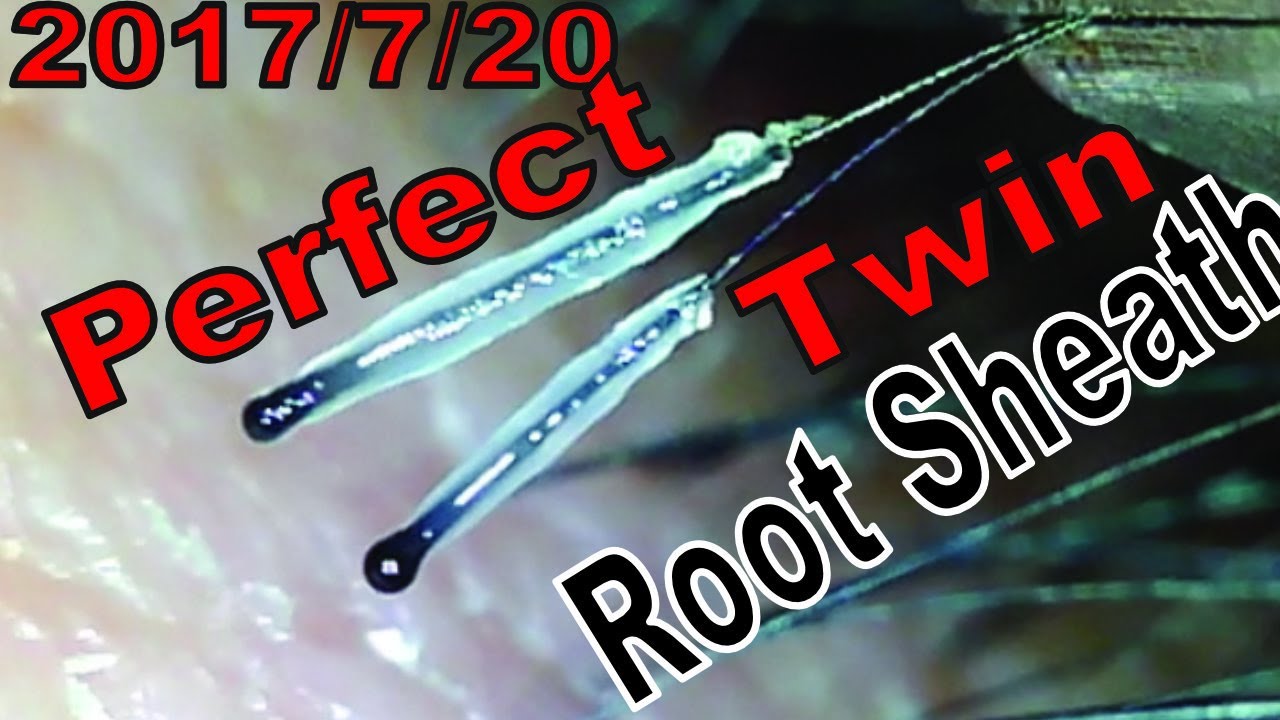 Hair Root Close Up Part 59 ずぼっとダブルで透明毛根鞘 Perfect Root Sheath Twin Youtube Hair Root Close Up Part 59 ずぼっとダブルで透明毛根鞘 Perfect Root Sheath Twin Youtube