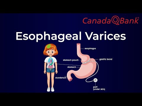 Video: Causes of esophageal varices