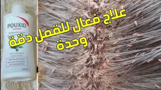 علاج القمل والتخلص والقضاء على القمل نهائيا بدواء فعال الحل الوحيد وطريقة إزالة قمل الشعر