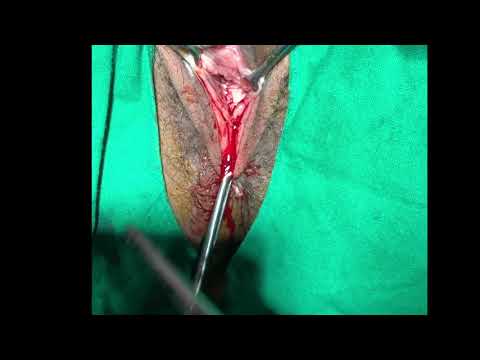 Video: Hymen Restoration With Hymenoplasty
