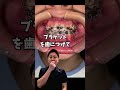 しっかり並べていきます✨#歯列矯正 #蒲田 #歯医者 #矯正