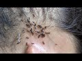 Pluck hundred head lice from short hair  pick out many head lice from long hair