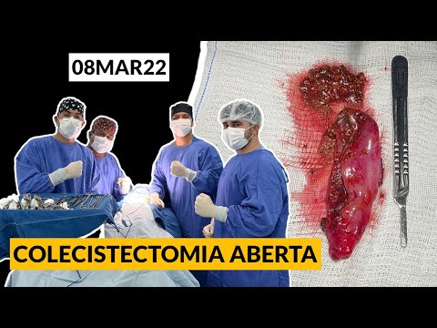 Ooforectomia • Oophorectomy - DR. LUCAS DUARTE [OUT21] 