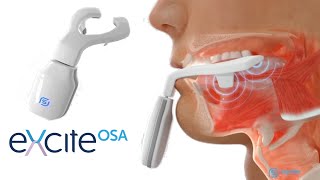 Exciteosa - Daytime Treatment For Mild Osa And Snoring Fda Approved Sleep Therapy Device
