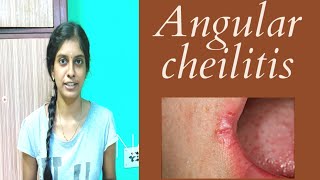 How to get rid of cracked lip corners(Angular cheilitis)? ||  உதட்டோரப் புண் குணமாக்குவது எப்படி?