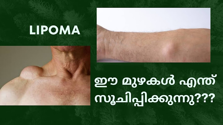 Lipoma - Small lumps seen in neck, hand, thighs, legs etc