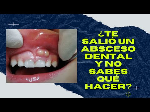 Video: 3 formas de deshacerse de una infección dental