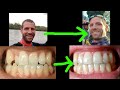 Before and After INVISALIGN - My Experience/Review  (Dr. Klatte)