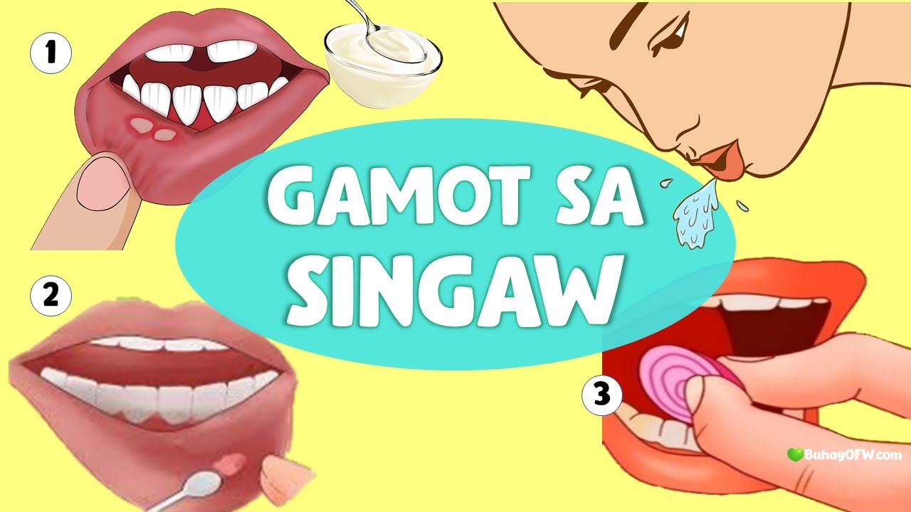 Natural Na Gamot Sa Singaw Sa Labi