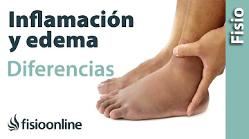 ¿Cuál es la causa más frecuente de edema en las piernas?