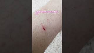 #string trimmers are dangerous
