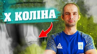 ЯК ВИРІВНЯТИ КОЛІНА / ІКС ПОДІБНІ КОЛІНА / ВПРАВИ ДЛЯ ВИРІВНЮВАННЯ КОЛІН