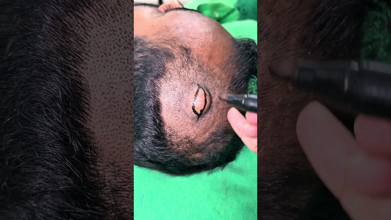 Pilar cyst pooping