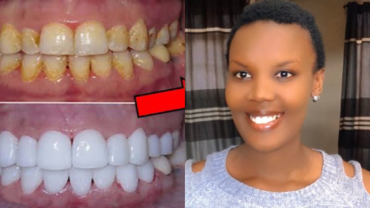 😲Ibi S’ugakabya muminota itarenze 3 gusa amenyo yarumuhondo aba ahindutse umweru/urumirwa nubikora✨🤗