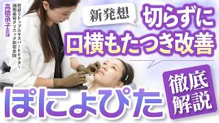 【口横のぽにょ改善】新発想スレッド治療「ぽにょぴた」徹底解説