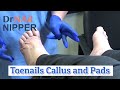 Toenails, Foot Calluses and Foot Pads [link moved] (2020)